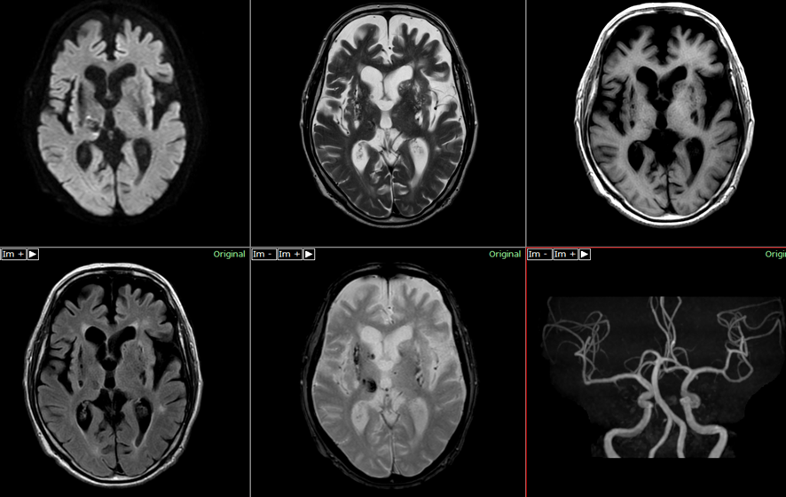 頭部MRI-脳出血