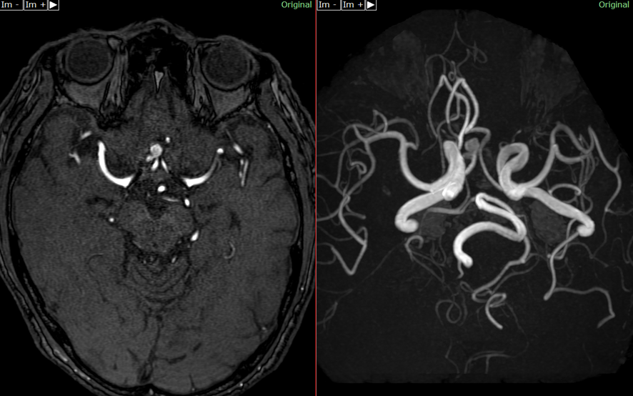 頭部MRI-前交通動脈瘤