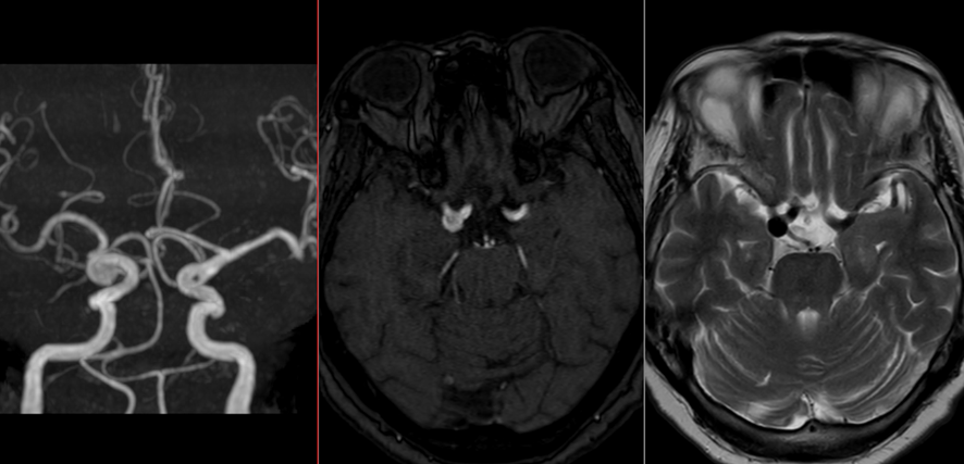 頭部MRI-内頚動脈瘤