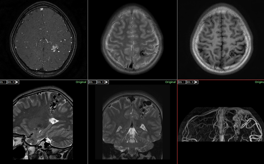 頭部MRI-AVM