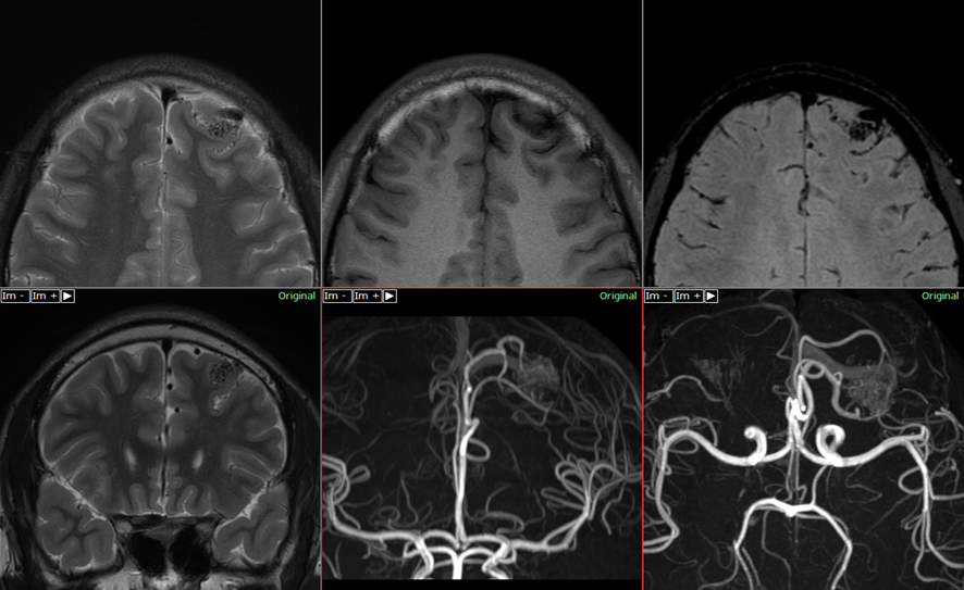 頭部MRI-脳動静脈奇形
