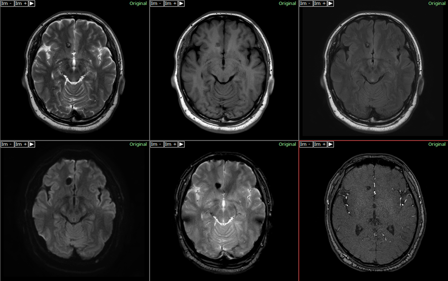 頭部MRI-海綿状血管腫2