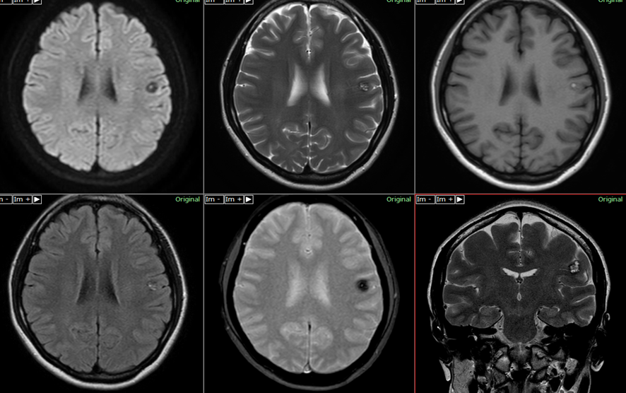 頭部MRI-海綿状血管腫