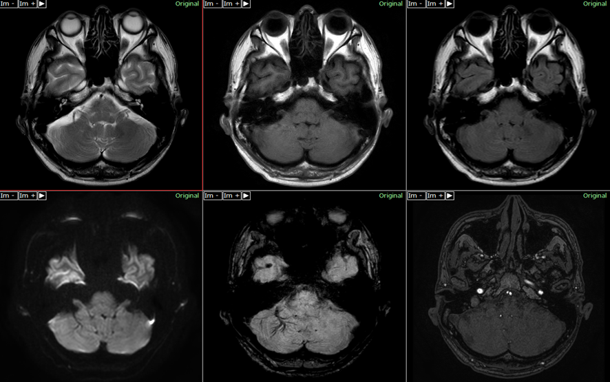 頭部MRI-小脳静脈奇形