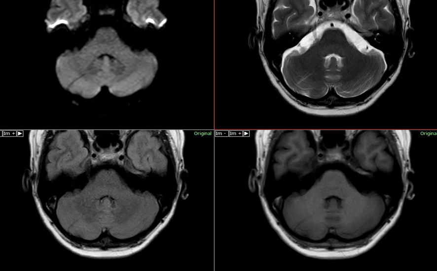 頭部MRI-静脈奇形