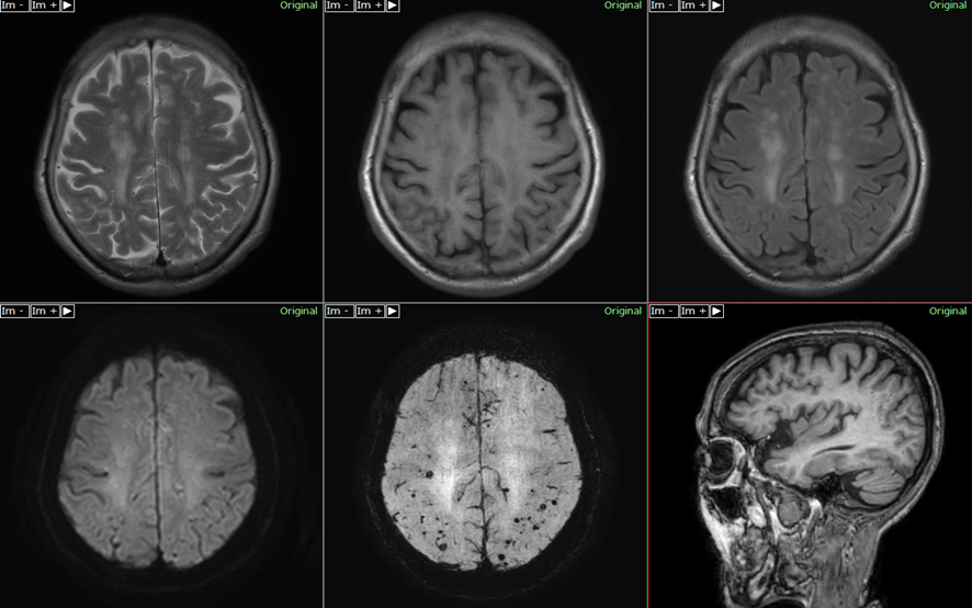 頭部MRI-アミロイドアンギオパチー
