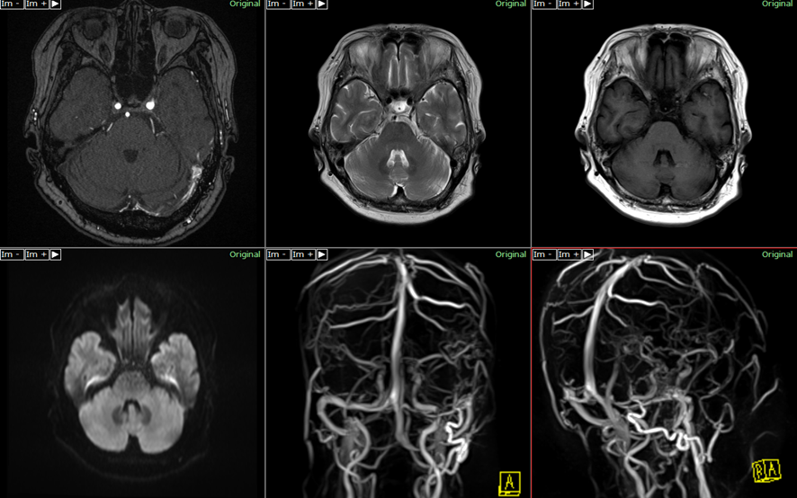 頭部MRI-dural-avf