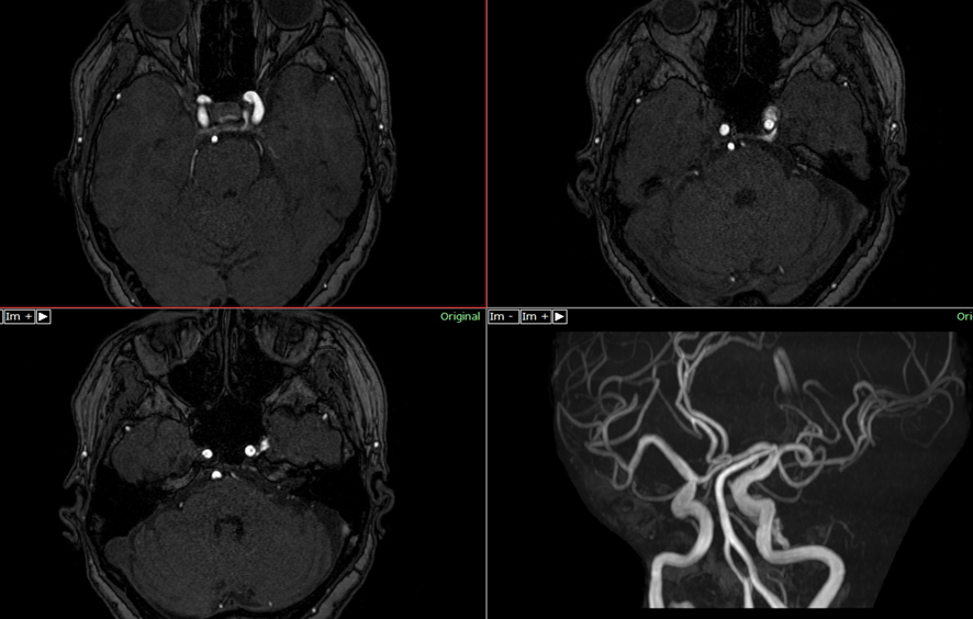 頭部MRI-海綿状血管腫