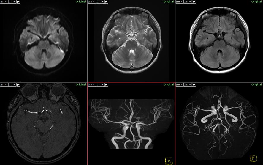 頭部MRI-RCVS（MCA）