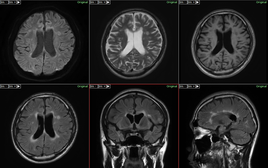 頭部MRI-多発性硬化症3