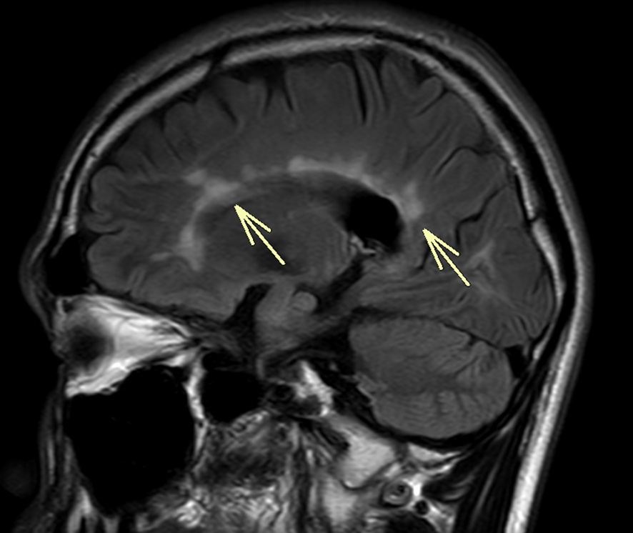 頭部MRI-多発性硬化症2