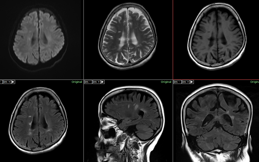 頭部MRI-多発性硬化症