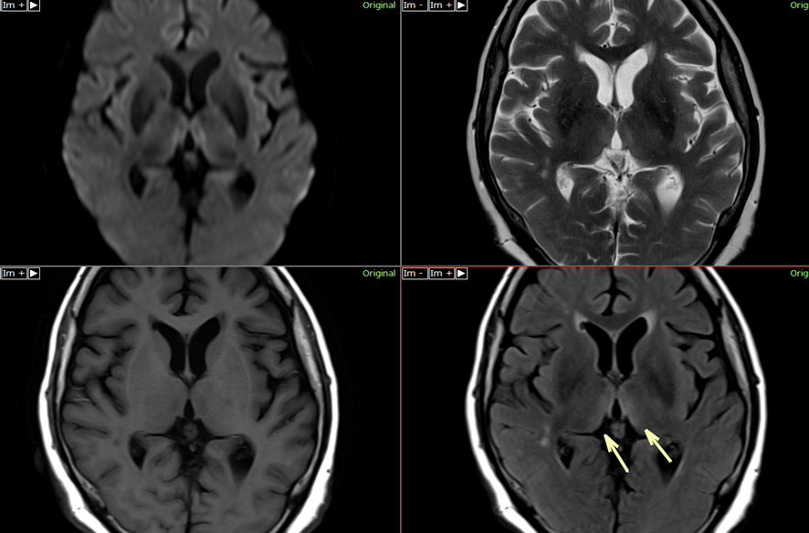 頭部MRI-ウェルニッケ脳症