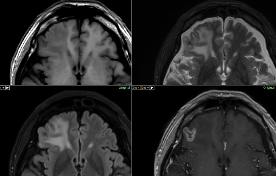頭部MRI-放射線壊死