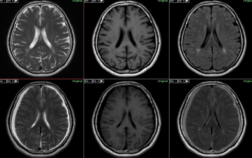 頭部MRI-低髄液圧症候群