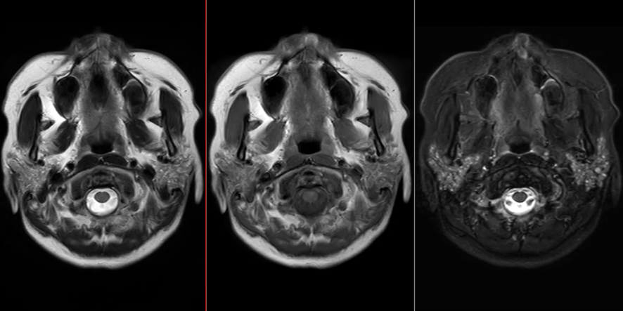 頸部MRI-シェーングレン症候群