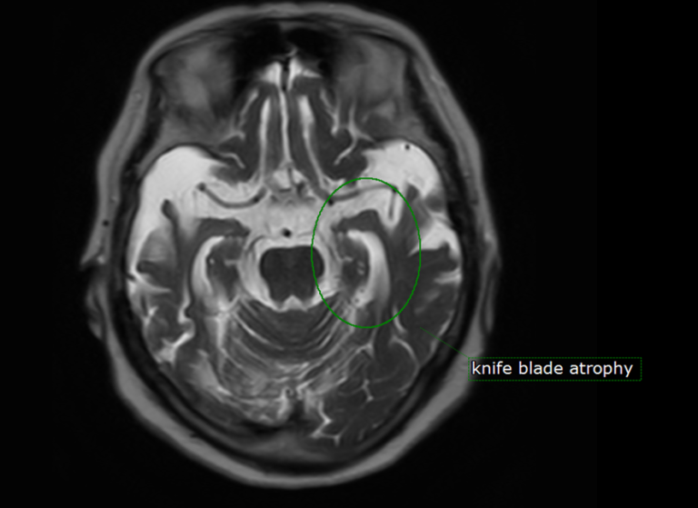 前頭側頭葉変性症（fronttemporal lobar degeneration）