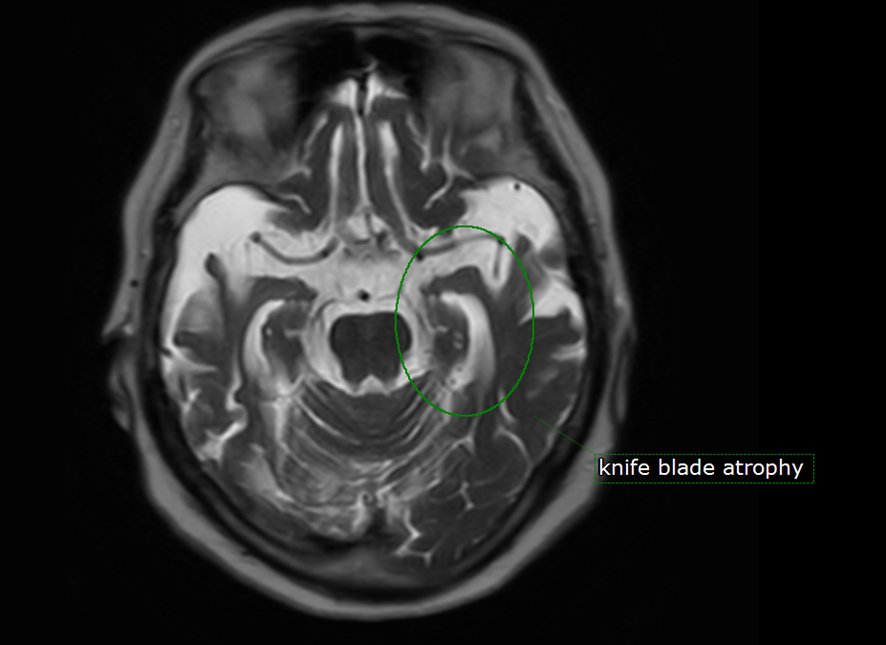 頭部MRI-kine-blade-atrophy