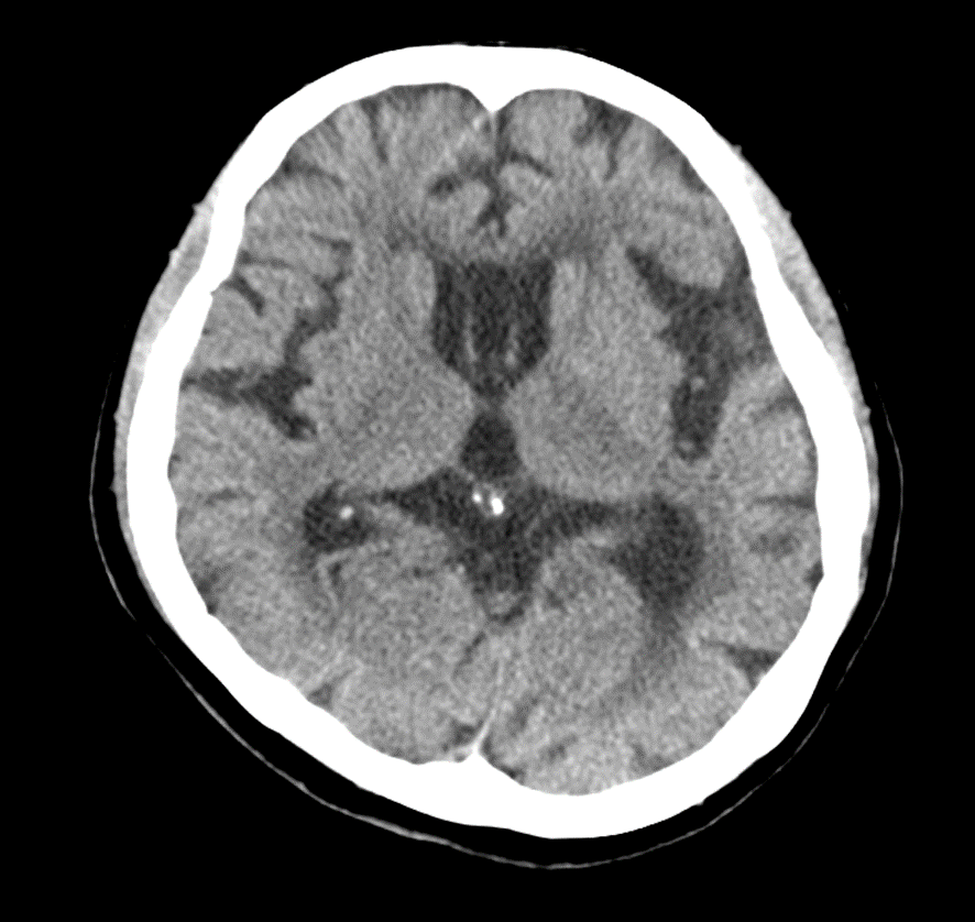 頭部CT-前頭側頭型変性症