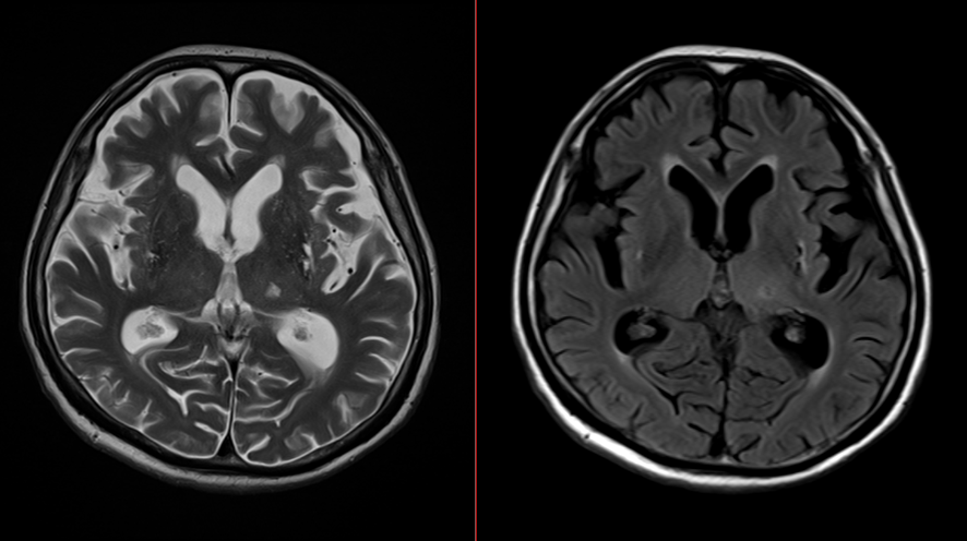 頭部MRI-血管性認知症3