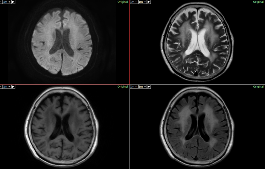 頭部MRI-血管性認知症2
