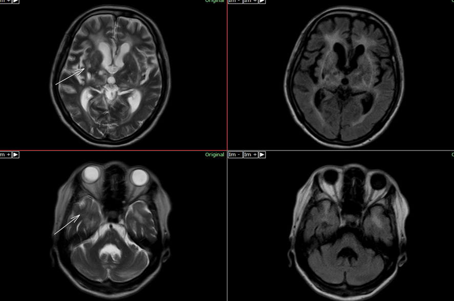 頭部MRI-CADASIL