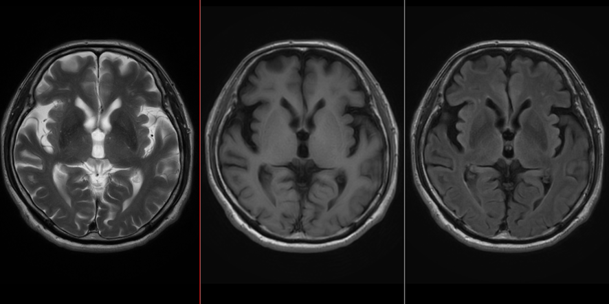 頭部MRI-パーキンソン病
