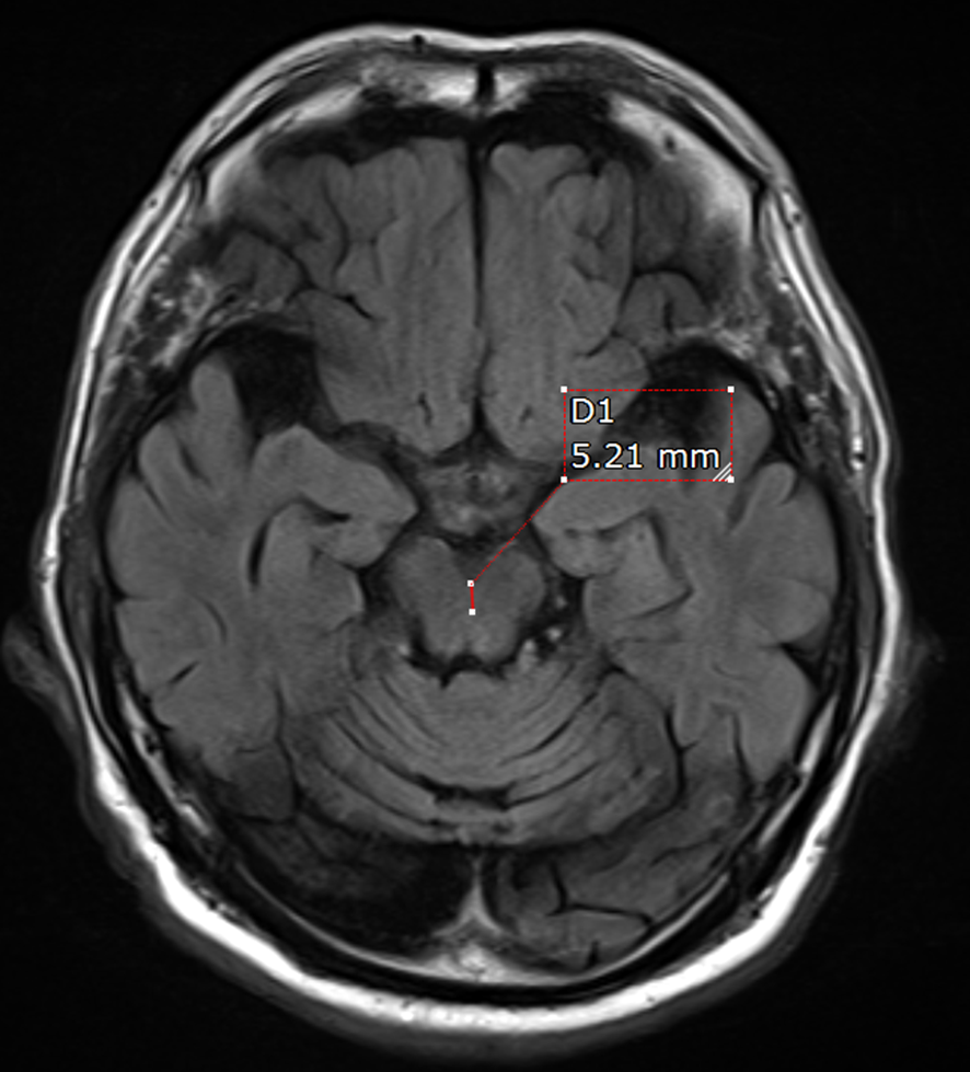 頭部MRI-進行性核上性麻痺2