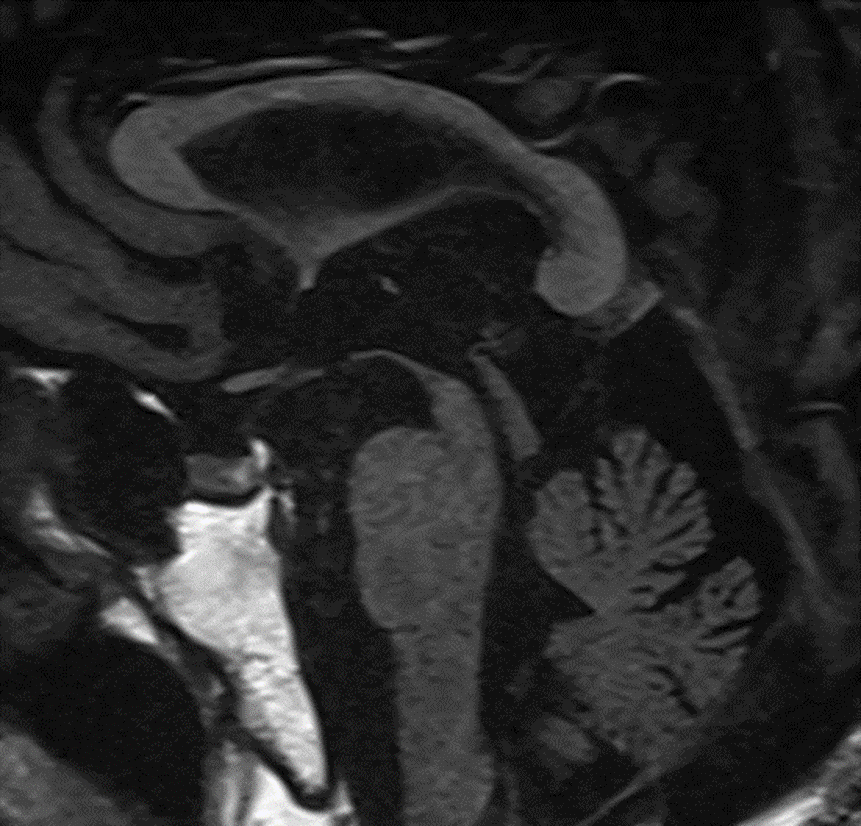 頭部MRI-進行性核上性麻痺