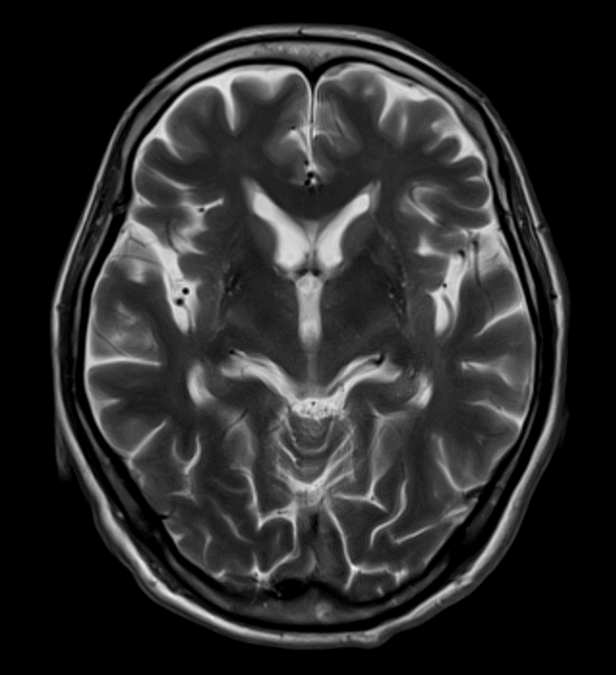 頭部MRI-MSA-P