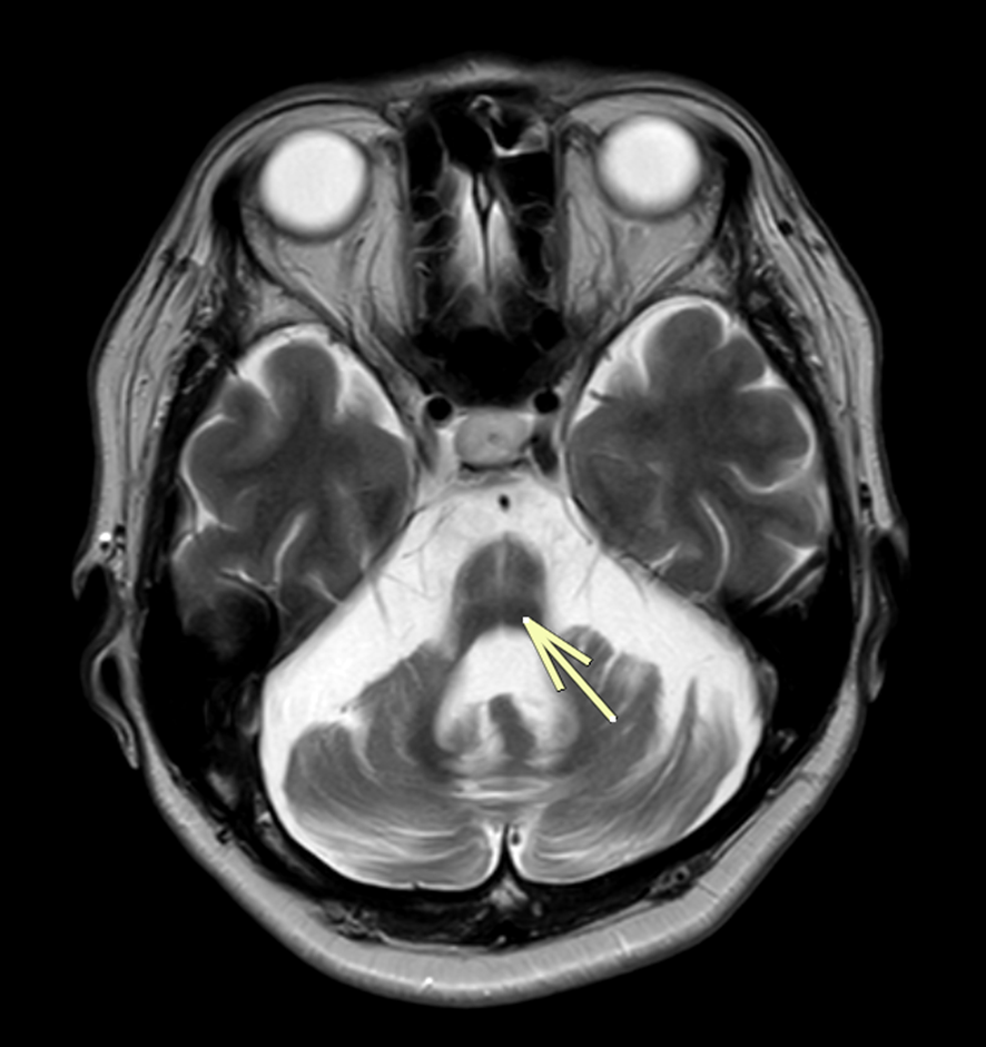 頭部MRI-多系統機能萎縮症