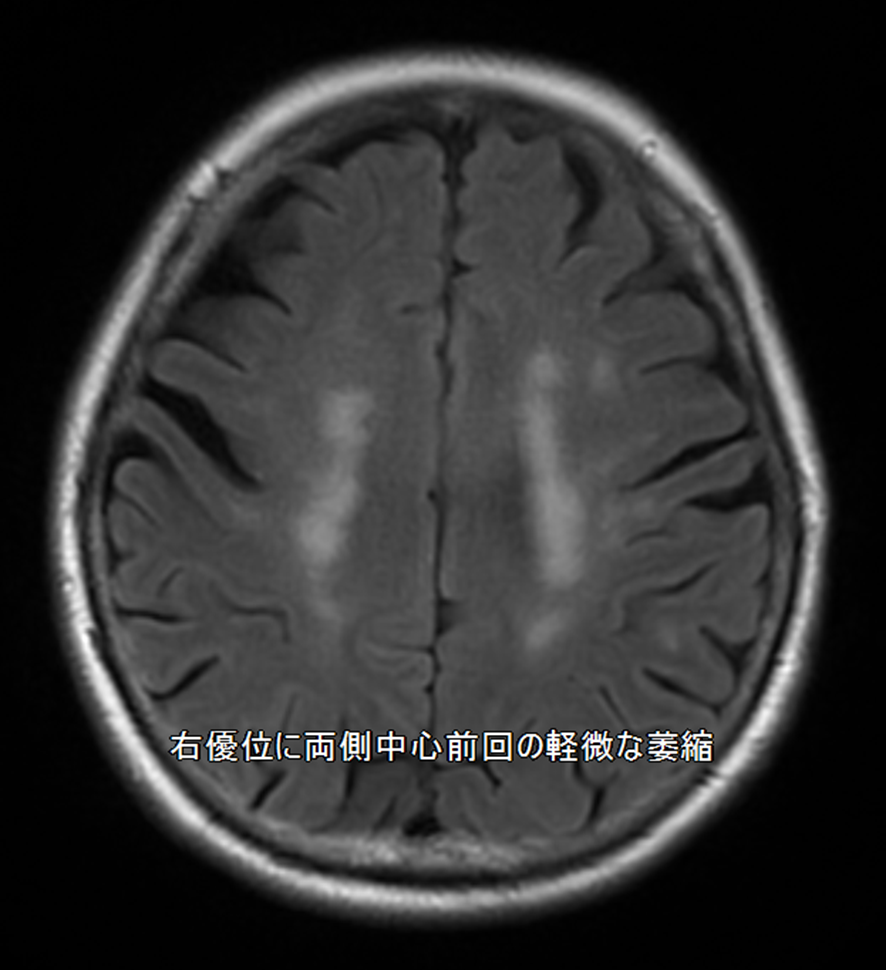 頭部MRI-大脳皮質基底核変性症