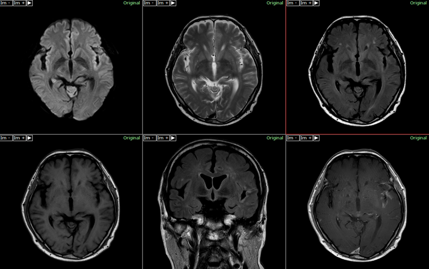頭部MRI-髄膜炎