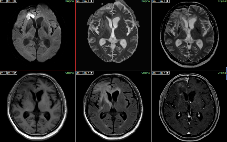 頭部MRI-脳膿瘍