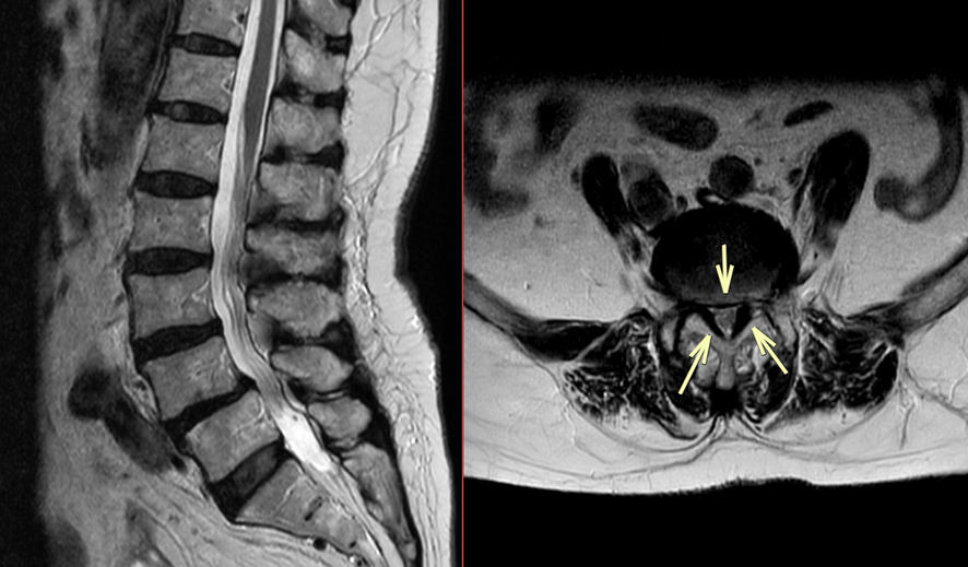 腰椎MRI-脊柱管狭窄症