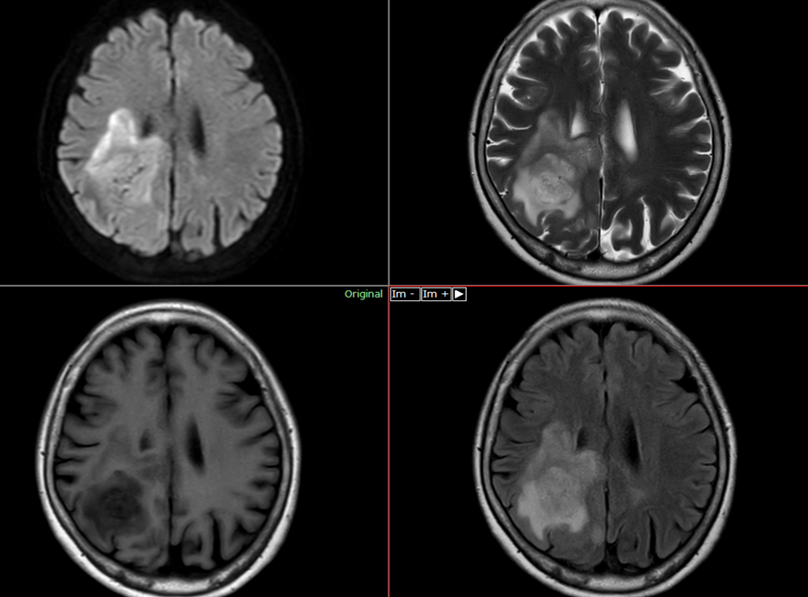 頭部MRI-脳膿瘍2