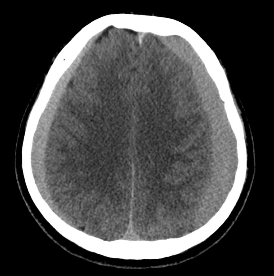 頭部CT-硬膜下血腫