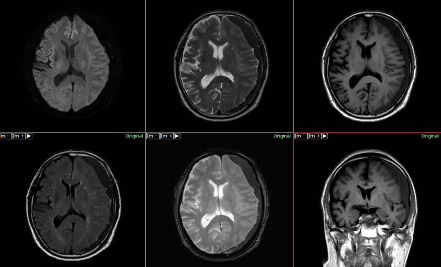 頭部MRI-慢性硬膜下血腫