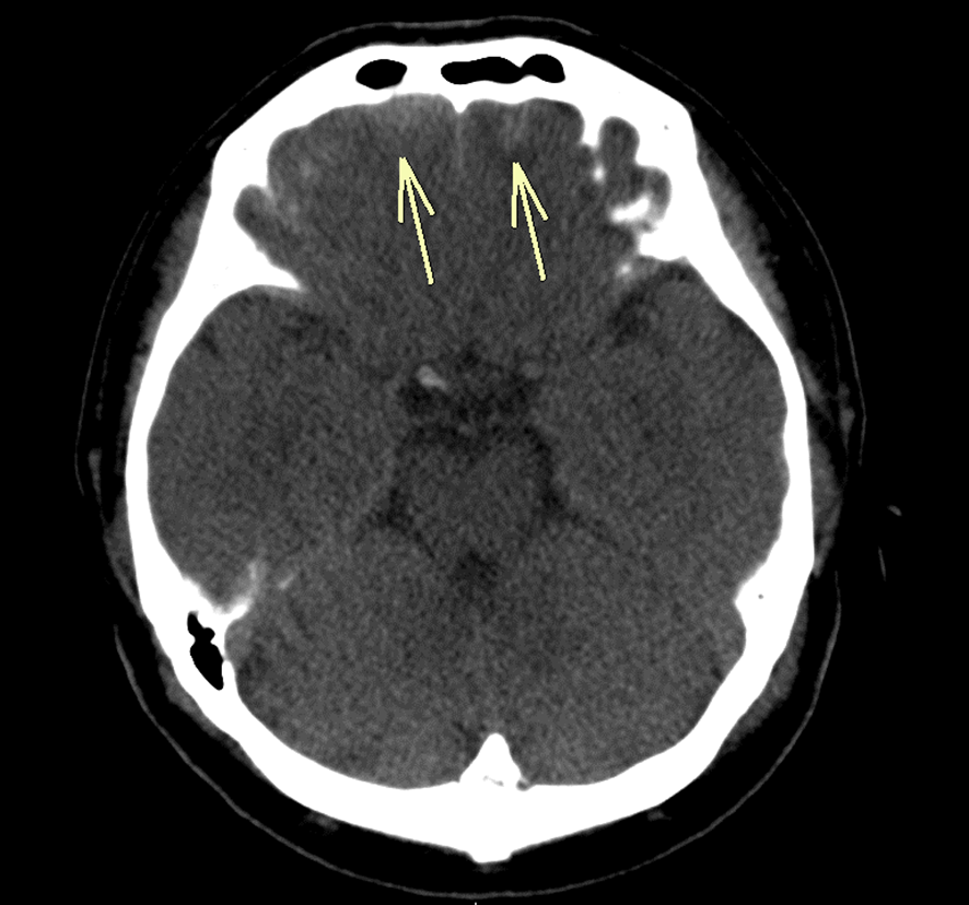 頭部CT-脳挫傷