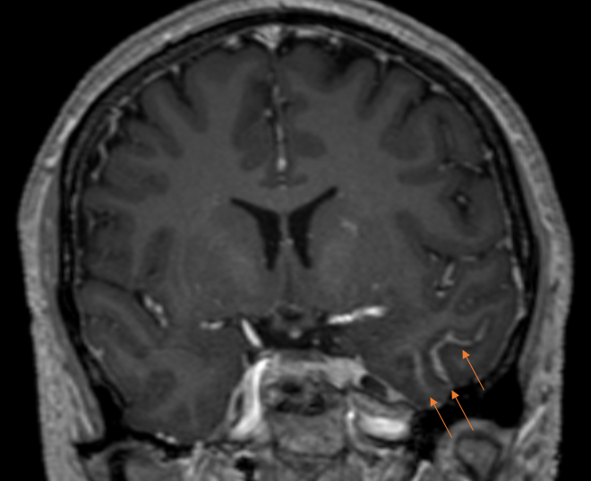 頭部MRI-髄膜炎