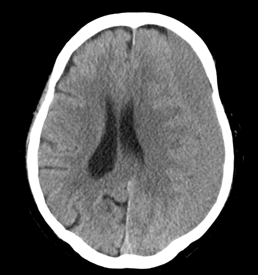 頭部CT-脳ヘルニア