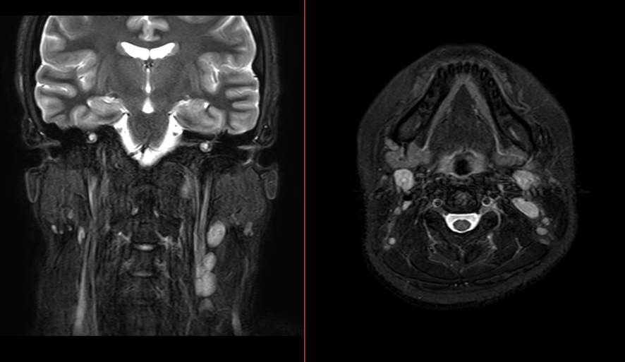 頸部MRI-急性リンパ節炎2