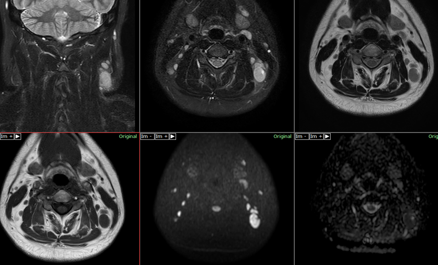 頸部MRI-急性リンパ節炎