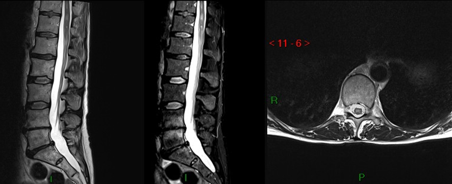 腰椎MRI-脊椎梗塞