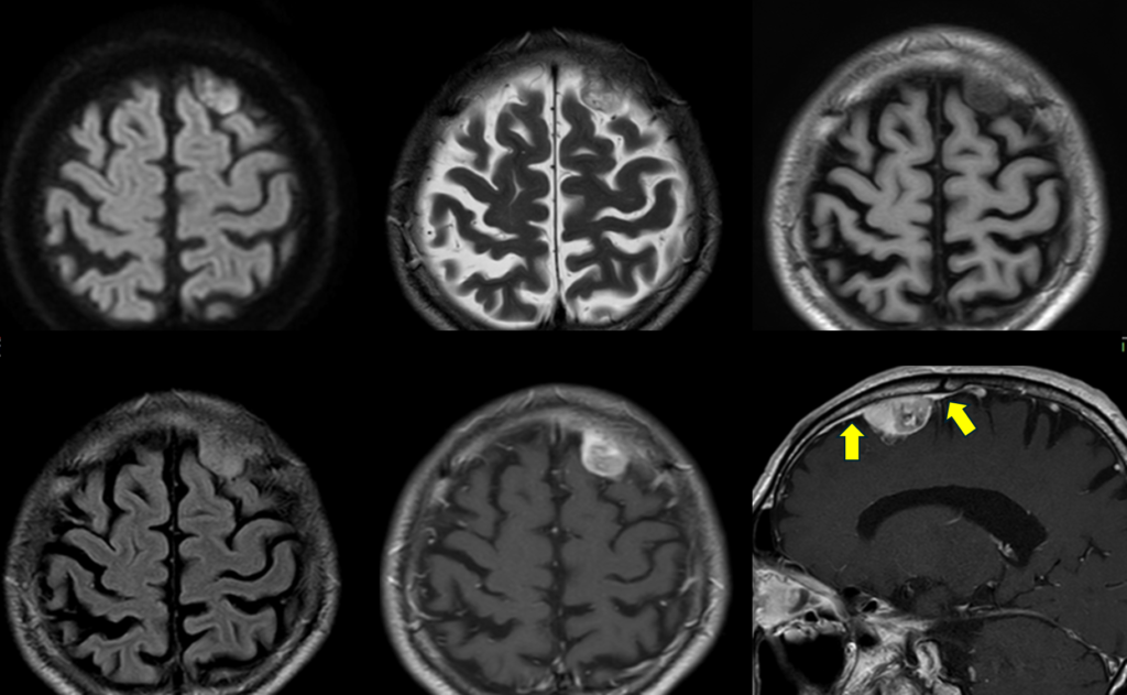 頭部MRI-dural-tail-sign