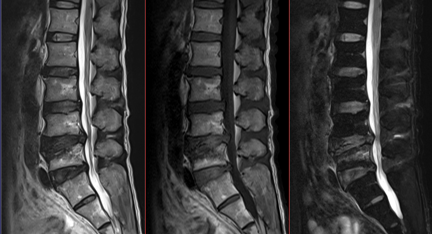 腰椎MRI-圧迫骨折