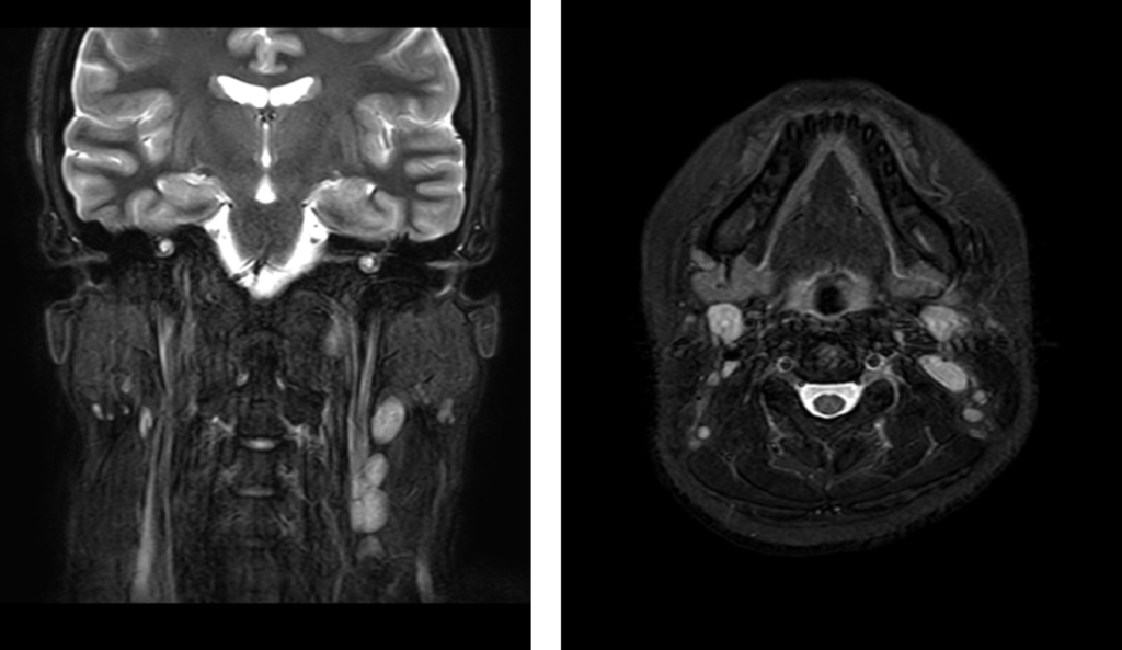 頸部MRI-急性リンパ節炎2