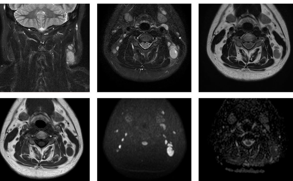 頸部MRI-急性リンパ節炎