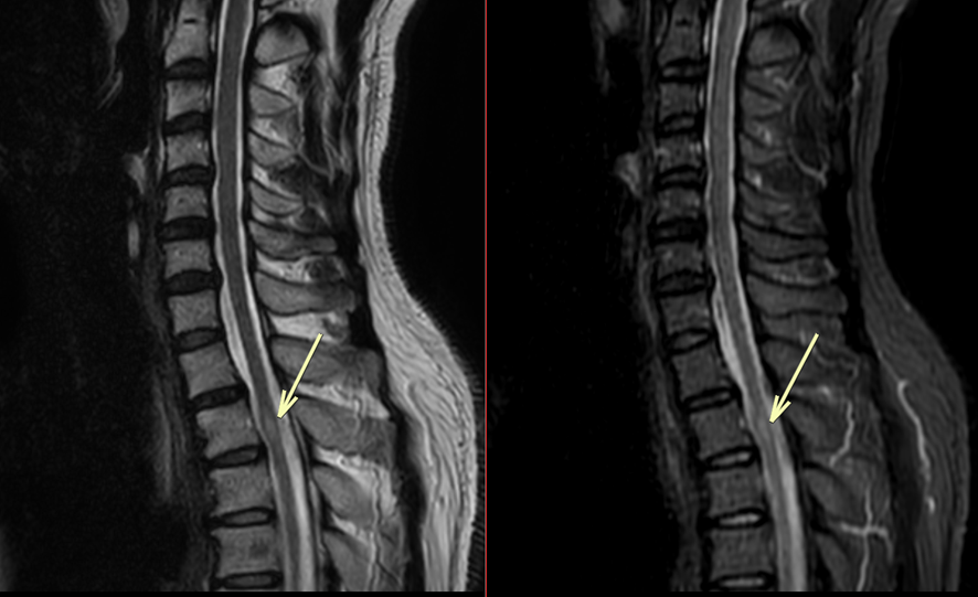 頚椎MRI-脊椎損傷