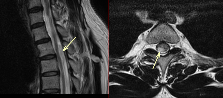 胸椎MRI-外傷性硬膜外血腫